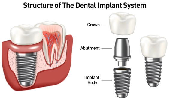 Dental Implant Procedure
